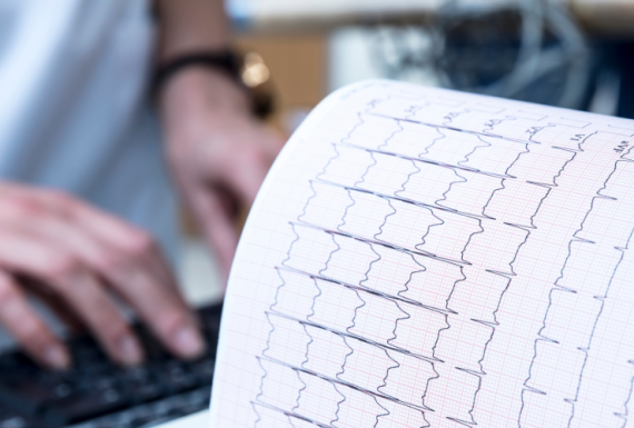 ECG (Electrocardiogram)