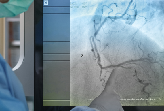Angiogram & Stenting